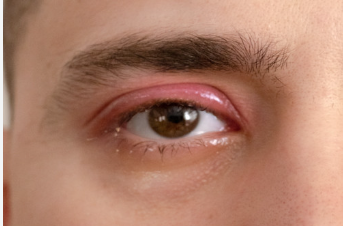 Why Are My Eyes Dry, Burning or Itchy? Common Causes Explained Blepharitis causing burning itchy and irritated eyes