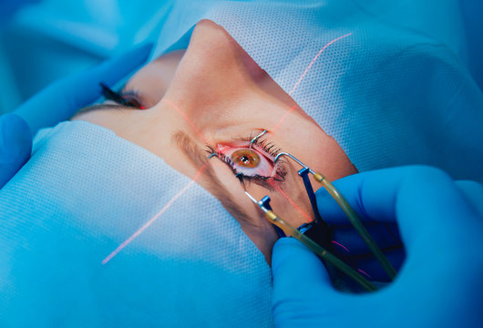 Cataract Surgery cataract surgery by a specialist .