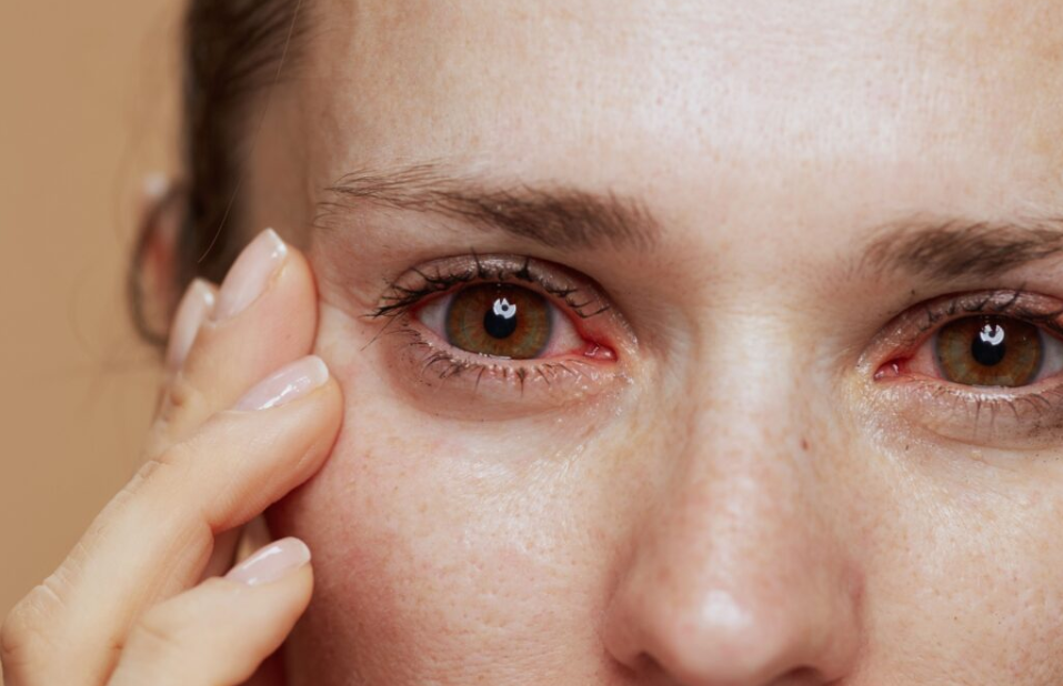 Why Do My Eyes Water? Common Causes & When to See a Doctor Itchy watery eyes associated with eye allergies