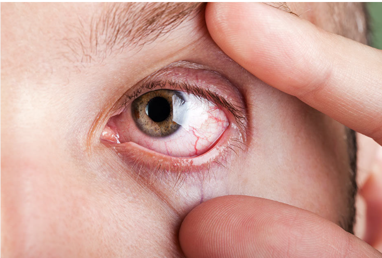 Reduced blinking during screen use can contribute to dry eyes
