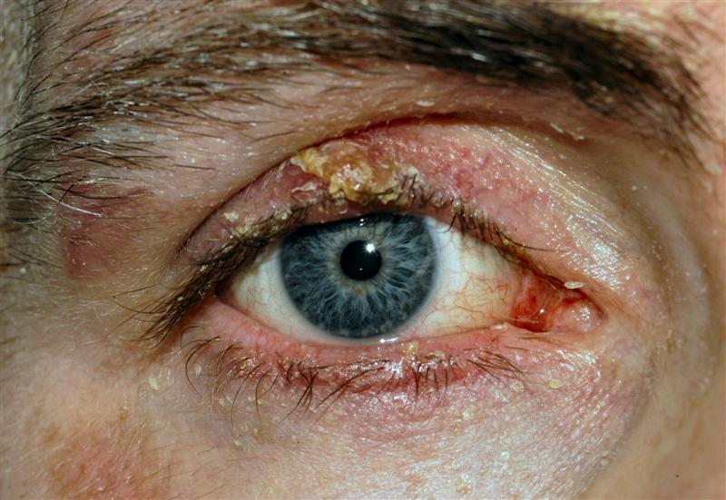 Why Do My Eyes Become Red? Causes of Red Eyes Blepharitis causing red, swollen and irritated eyelids