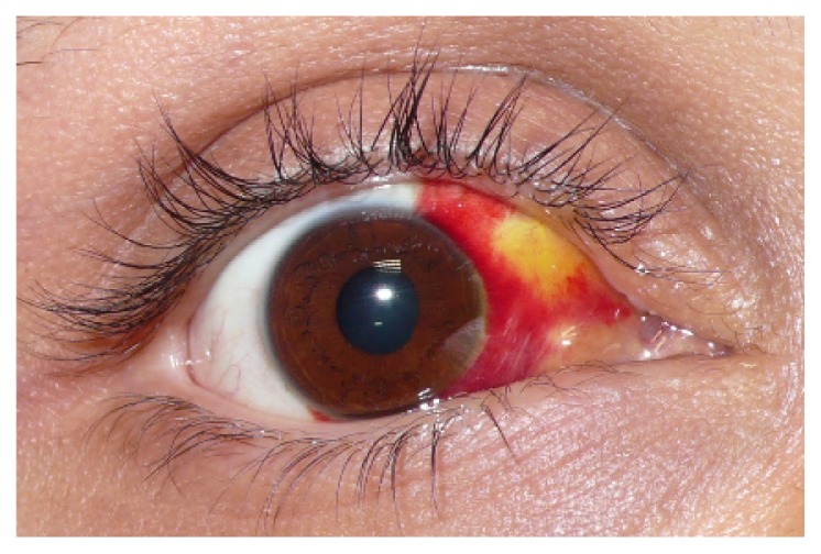 Why Do My Eyes Become Red? Causes of Red Eyes Bright red patch from a broken blood vessel in the eye