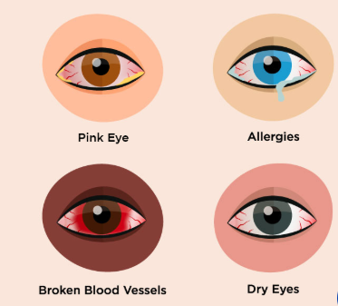 Why Do My Eyes Become Red? Causes of Red Eyes Different types of eye redness and bloodshot eyes