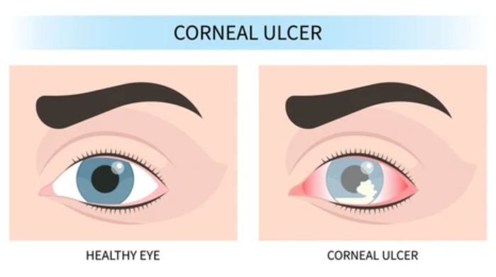 Eye Pain: Common Causes and When It Needs Medical Attention Corneal irritation causing eye pain and light sensitivity
