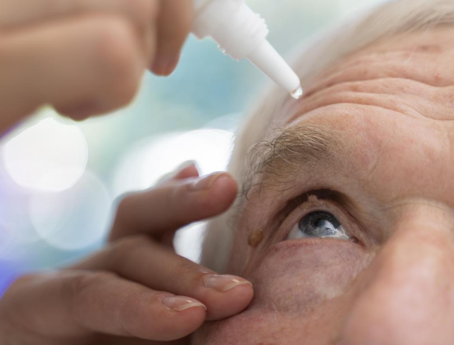 How Long Does It Take to Recover After Cataract Surgery? Applying prescribed eye drops during cataract surgery recovery