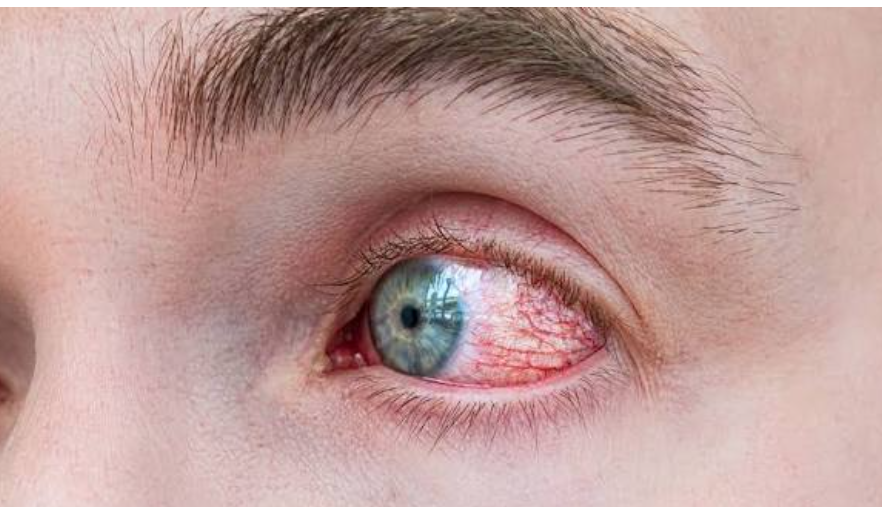 Warning Signs After Eye Surgery: When Should You See a Doctor? Eye pain warning signs including redness, irritation, and discomfort